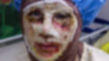 اسید پاشی روی یک زن و دخترش توسط برادر شوهر در لرستان تیر 94